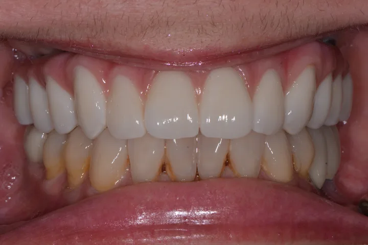 After full-arch fixed implant teeth at Terrell Advanced Dentistry