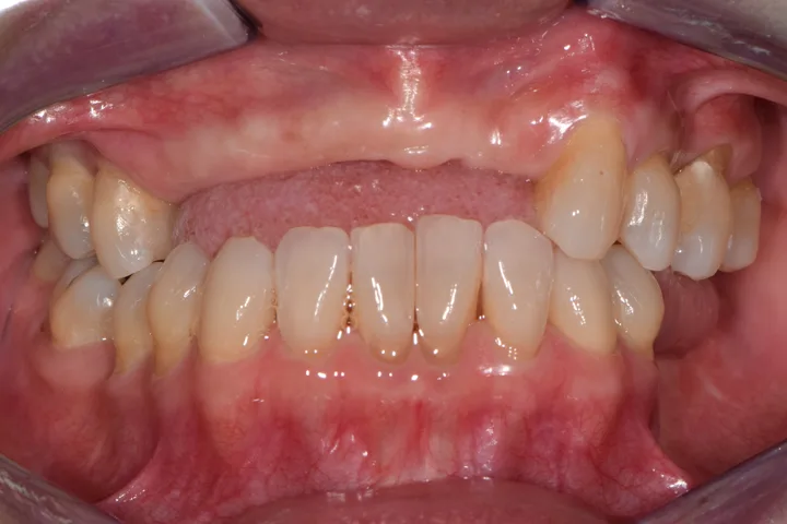 Before full-arch fixed implant teeth at Terrell Advanced Dentistry