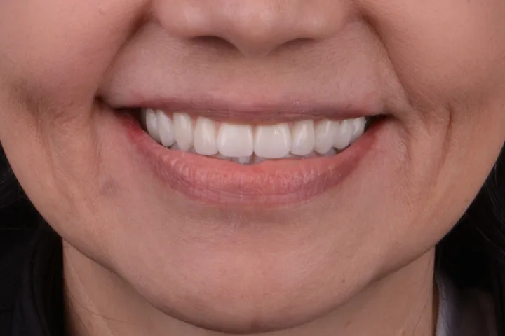 After full-arch fixed implant teeth at Terrell Advanced Dentistry