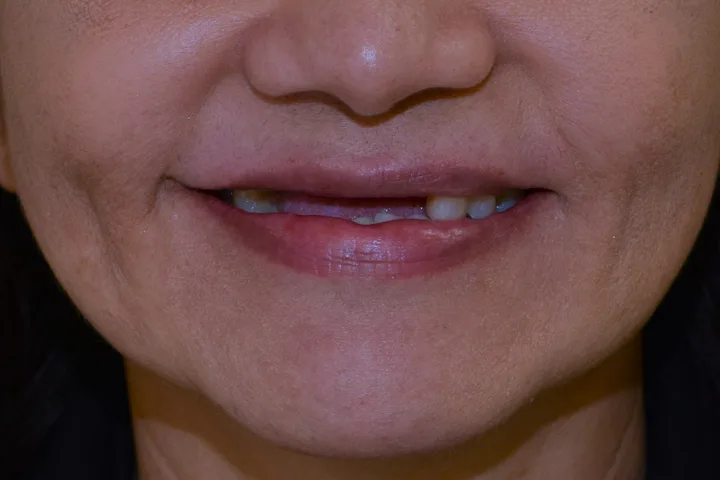 Before full-arch fixed implant teeth at Terrell Advanced Dentistry