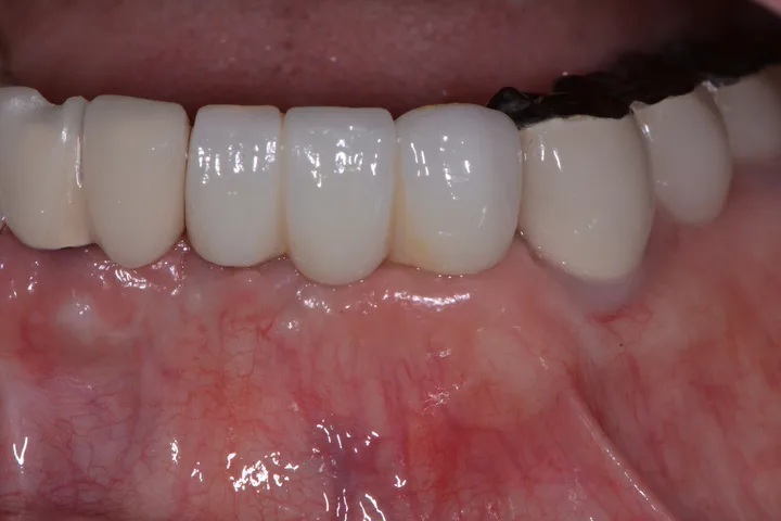 After lower implant bridge at Terrell Advanced Dentistry