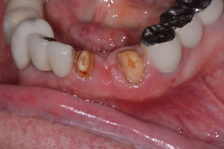 Before lower implant bridge at Terrell Advanced Dentistry