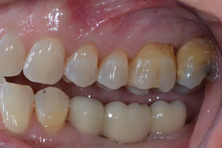 After implant bridge at Terrell Advanced Dentistry