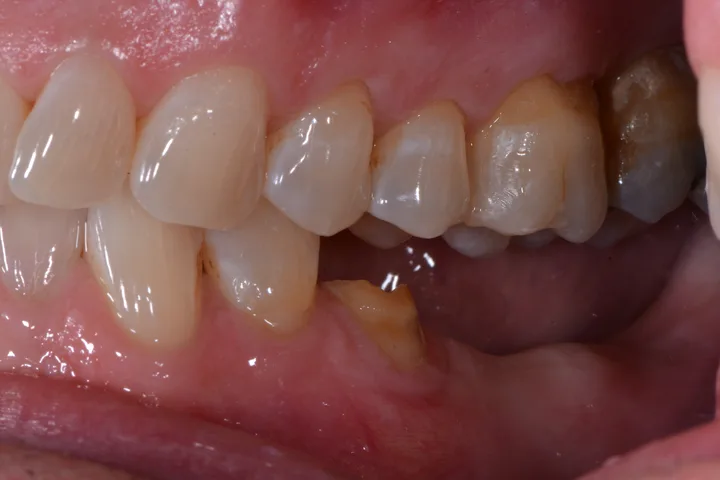 Before implant bridge at Terrell Advanced Dentistry