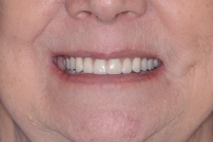 After complete denture at Terrell Advanced Dentistry