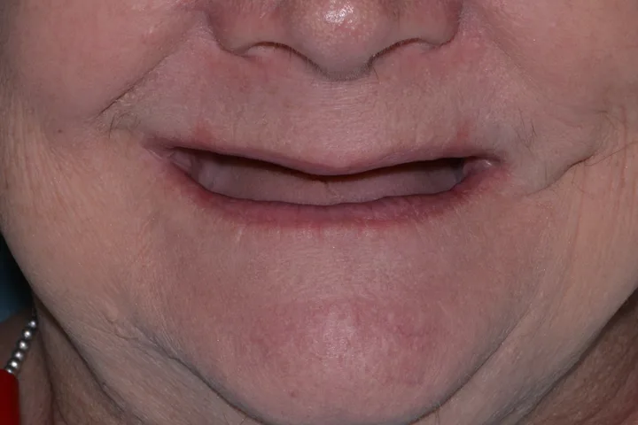 Before complete denture at Terrell Advanced Dentistry