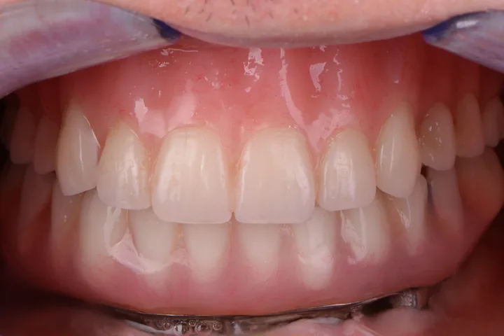 After implant-supported lower denture at Terrell Advanced Dentistry