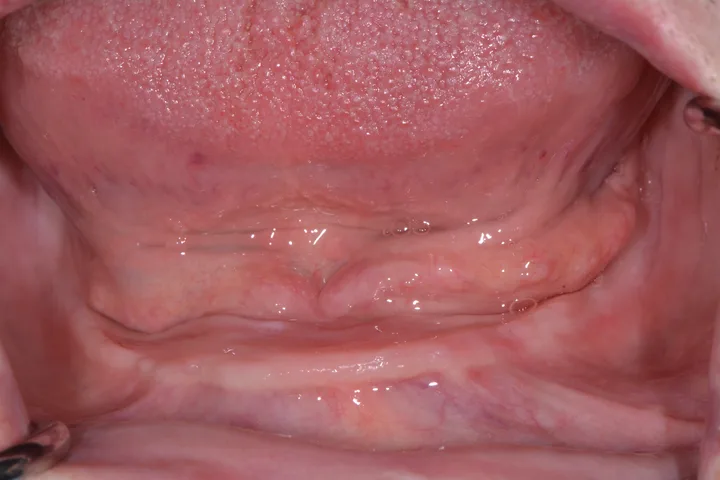 Before implant-supported lower denture at Terrell Advanced Dentistry