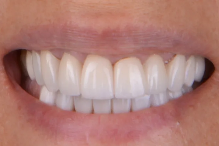 After full-mouth rehabilitation at Terrell Advanced Dentistry