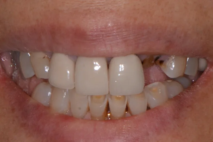 Before full-mouth rehabilitation at Terrell Advanced Dentistry