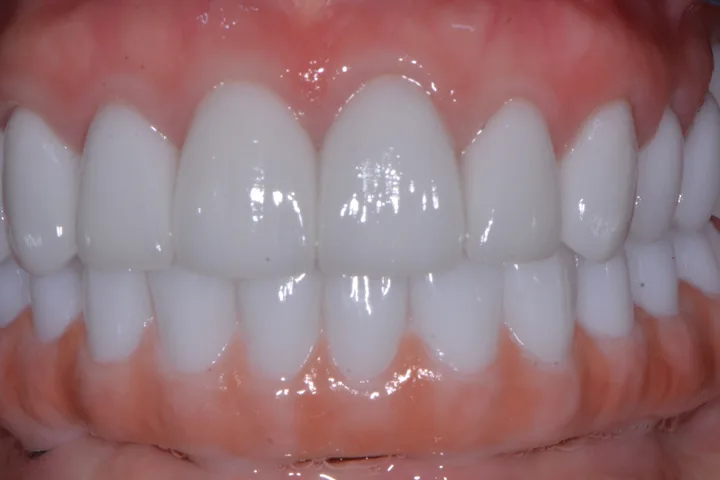 After full-mouth rehabilitation with implant overdenture at Terrell Advanced Dentistry