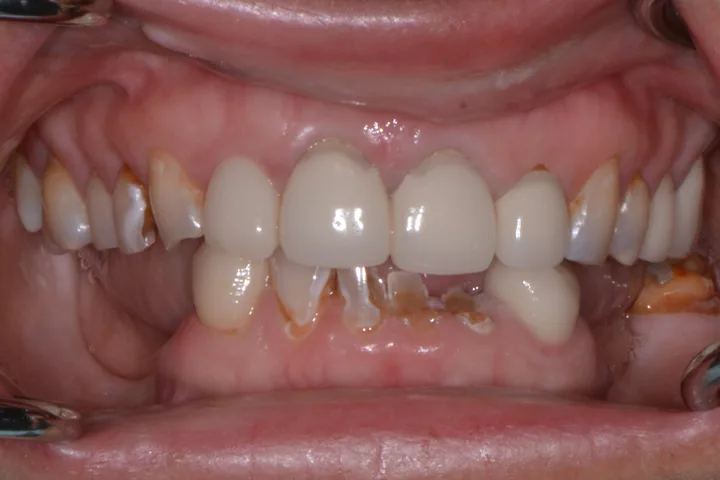 Before full-mouth rehabilitation with implant overdenture at Terrell Advanced Dentistry