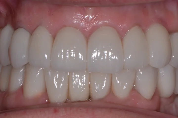 After full-mouth rehabilitation at Terrell Advanced Dentistry