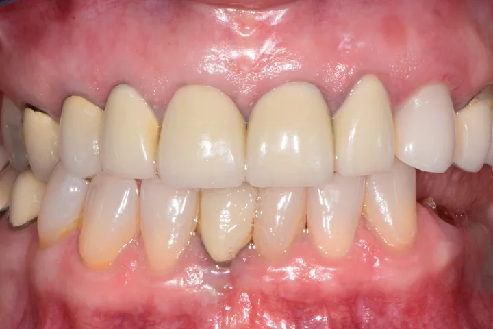 Before full-mouth rehabilitation at Terrell Advanced Dentistry