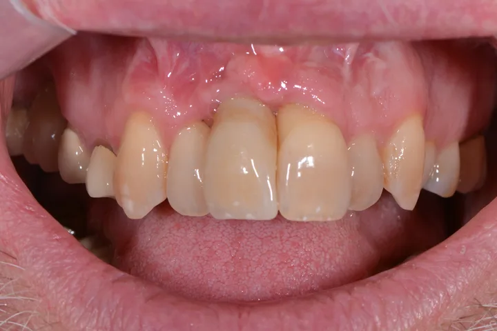 After single dental implant and crown replacing a missing front tooth at Terrell Advanced Dentistry
