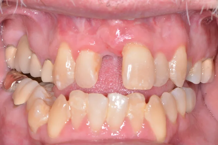 Before single dental implant and crown replacing a missing front tooth at Terrell Advanced Dentistry