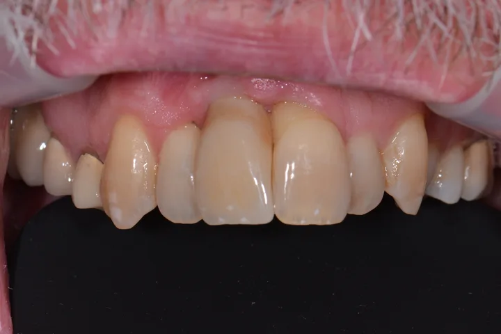 After single dental implant and crown replacing a missing front tooth at Terrell Advanced Dentistry
