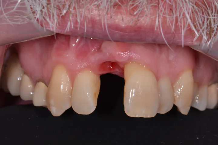 Before single dental implant and crown replacing a missing front tooth at Terrell Advanced Dentistry