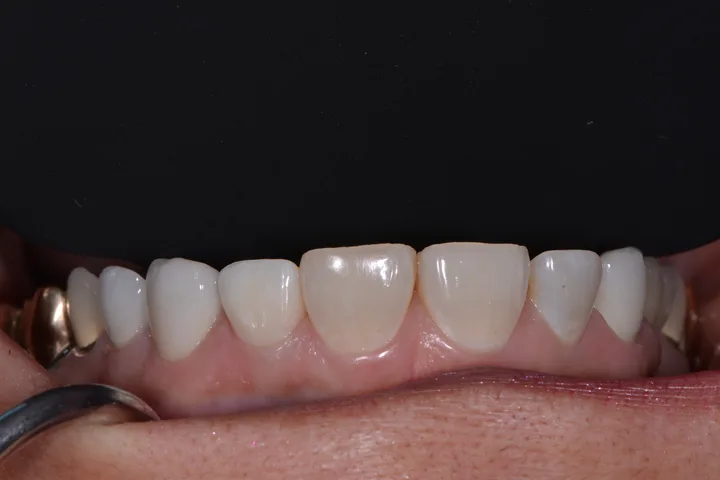 After single dental implant and crown replacing a missing front tooth at Terrell Advanced Dentistry