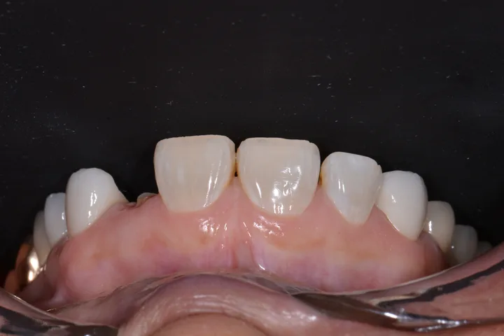 Before single dental implant and crown replacing a missing front tooth at Terrell Advanced Dentistry