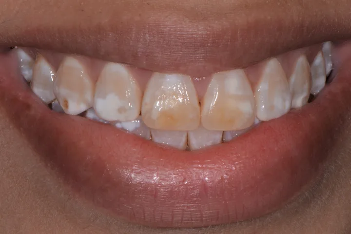 Before porcelain veneers at Terrell Advanced Dentistry